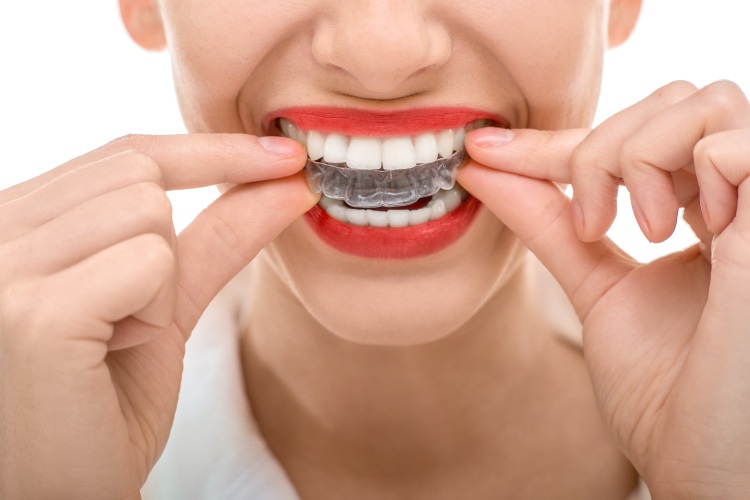 Woman with red lipstick smiles as she puts in her clean Invisalign trays to straighten her teeth