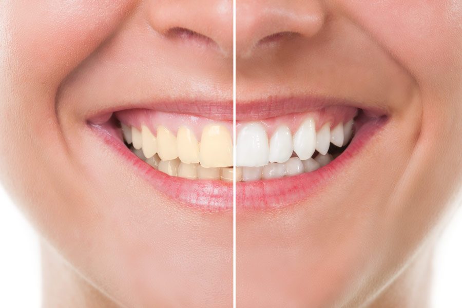 A smile that is half yellow and half white to show the benefits of teeth whitening
