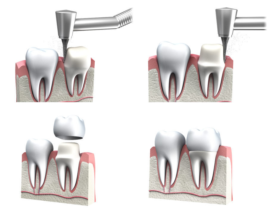 Diagram showing the steps to prepare for placement of a dental crown