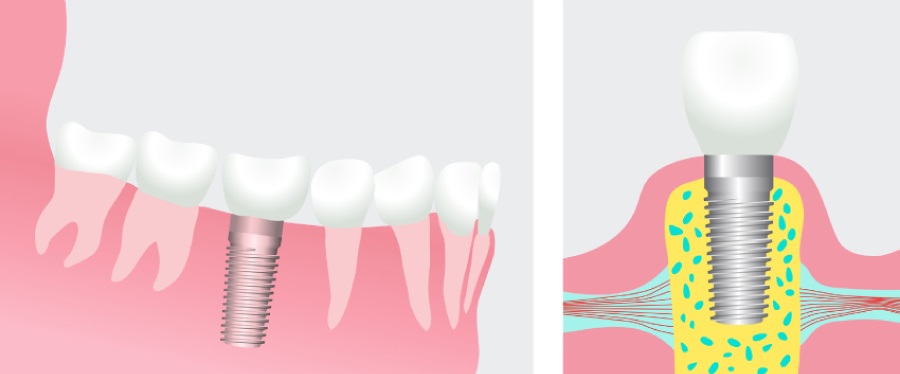 Graphic illustration of a dental implant and restoration