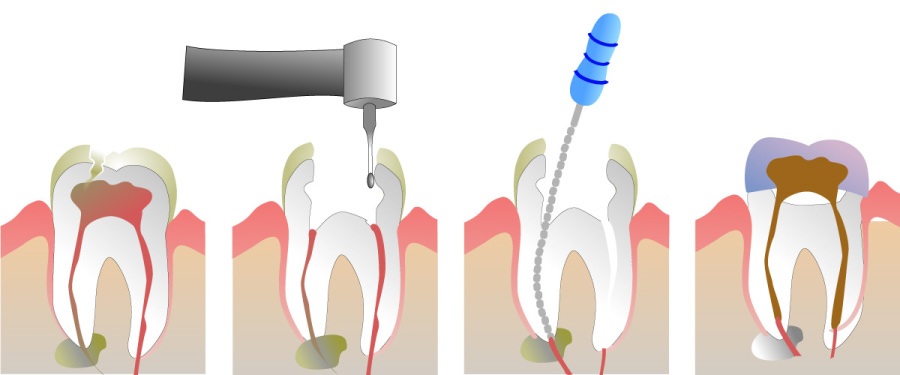 Graphic illustration of four steps of root canal treatment