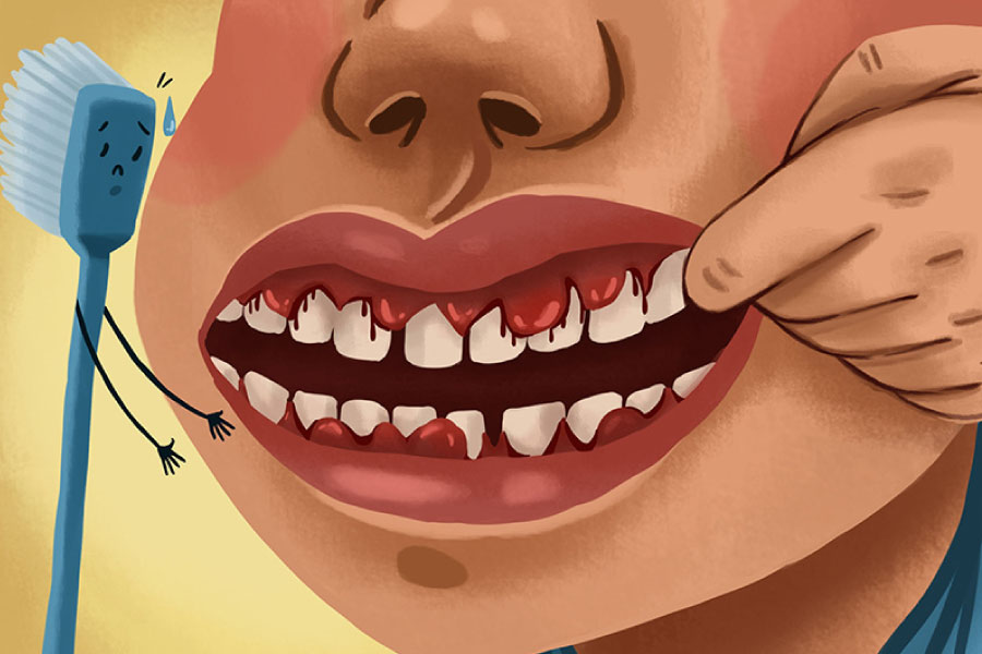 Cartoon of an individual with bleeding gums due to gingivitis.