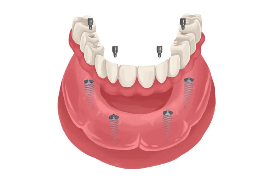 Model of implant supported dentures.