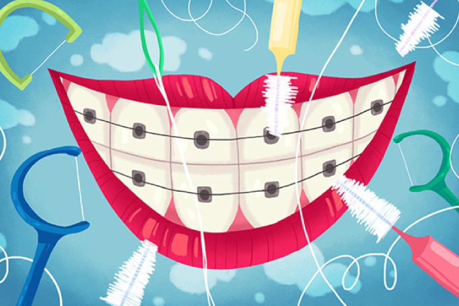 Cartoon smile with braces and cleaning instruments.