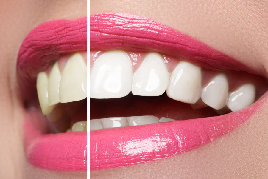 Close up of a pink lipsticked smile showing the results of teeth whitening on one side.