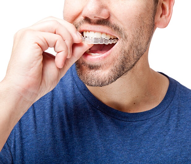 man inserting a clear aligner onto his teeth