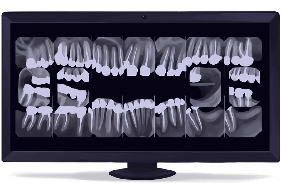 Computer screen showing a dental x-ray.
