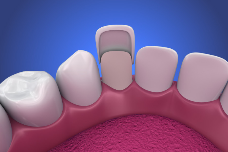 Model showing the placement of a dental veneer on a tooth.