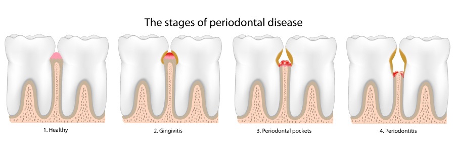 Chart showing the stages of gum disease.