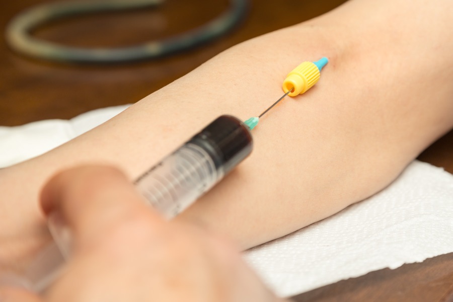 Photo showing the injection needed for IV sedation.