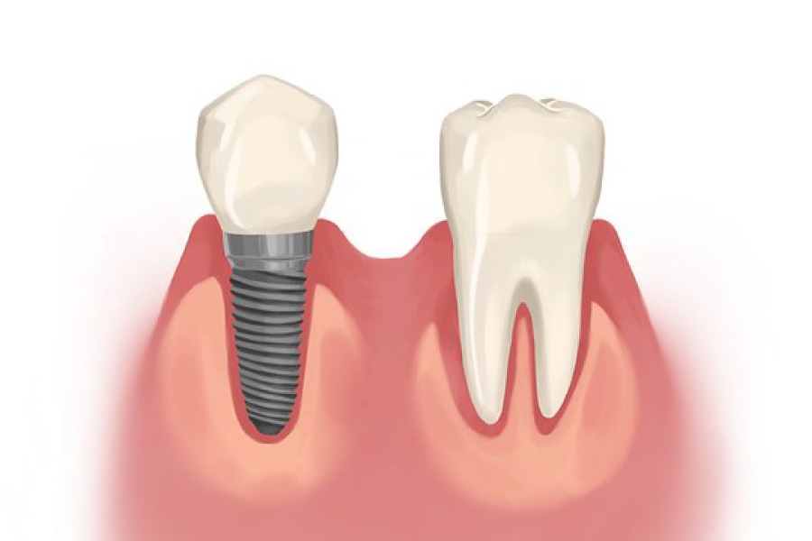 Graphic showing a dental implant next to a natural tooth.