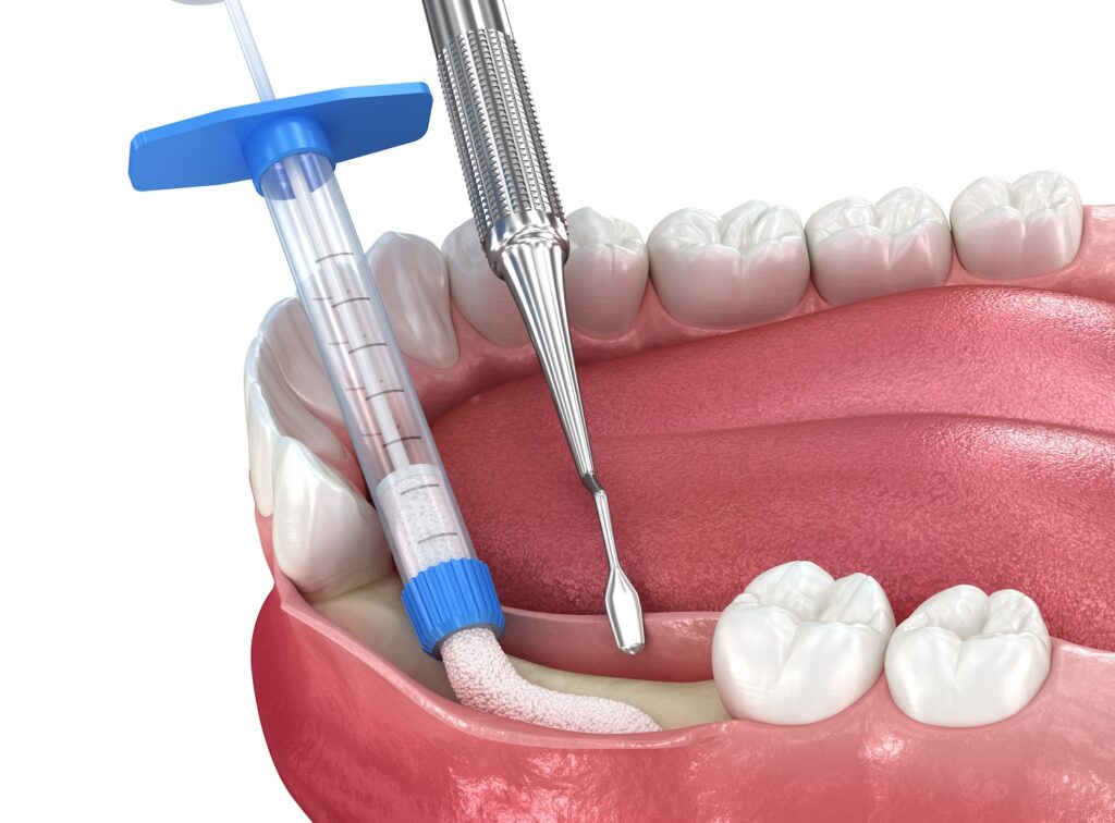 regenerative bone grafting, medically accurate 3d illustration