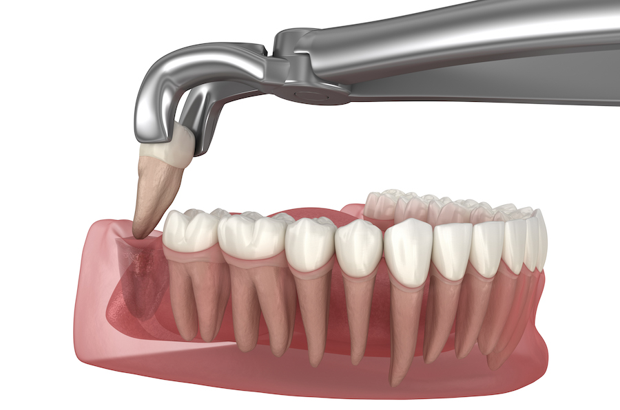 wisdom tooth extraction, wisdom teeth extraction, simple extraction, surgical extraction, 3rd molars