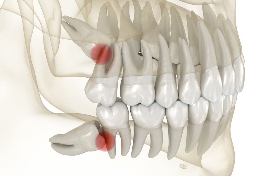 wisdom tooth removal, wisdom tooth extraction, wisdom teeth pain, wisdom teeth, oral surgery, when should i get my wisdom teeth out