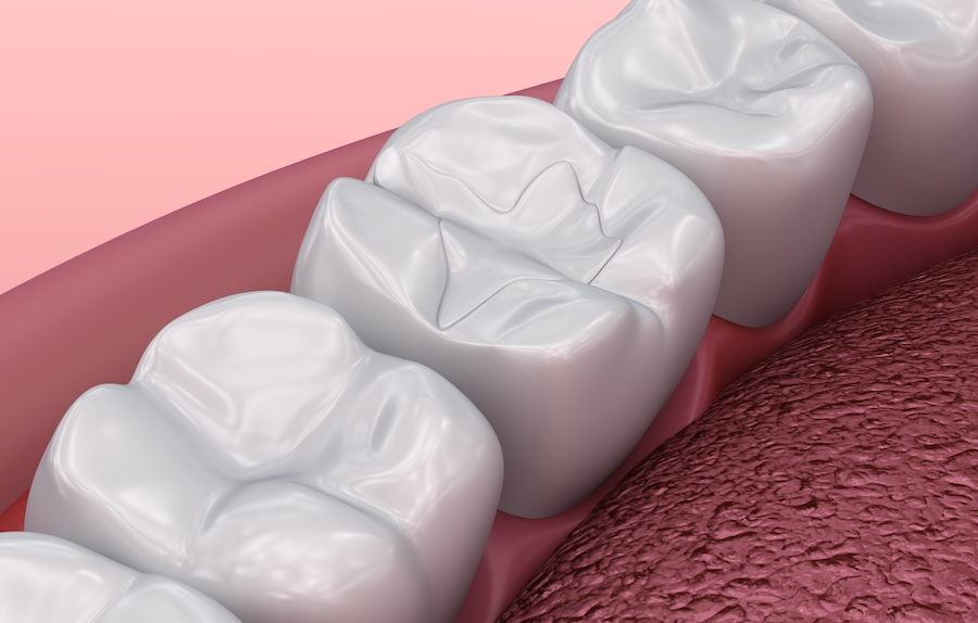image of dental filling, reasons for dental fillings