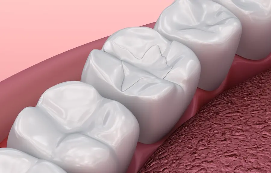 image of dental filling, reasons for dental fillings