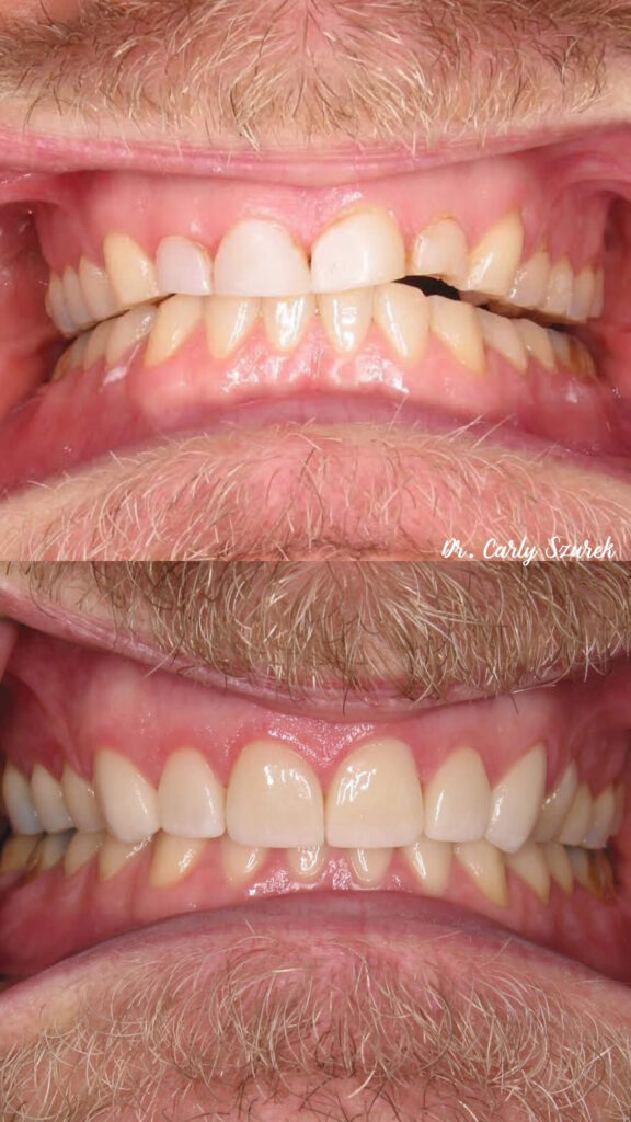 before and after veneers