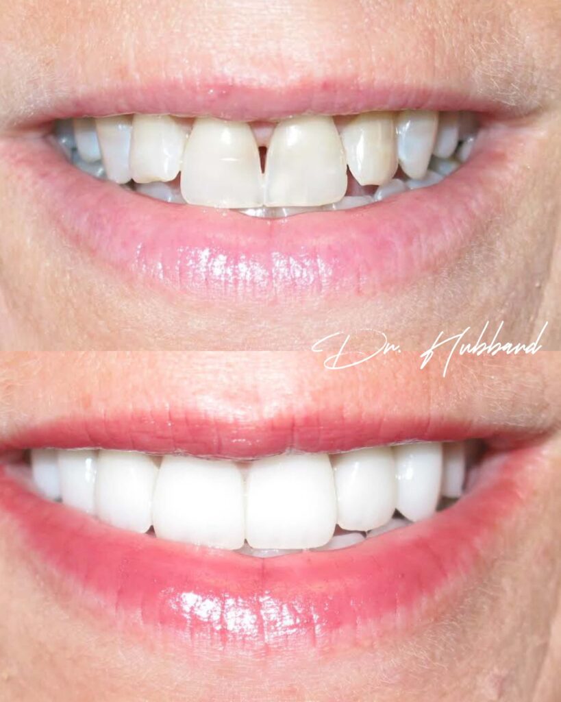 before and after veneers