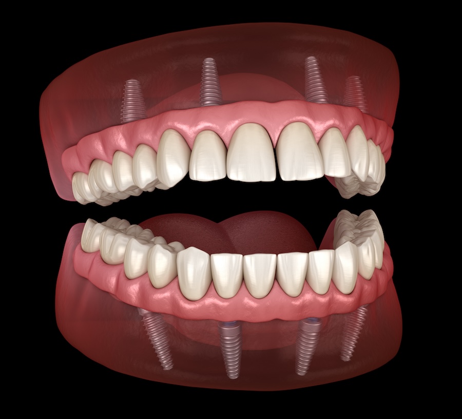 all on 4 dentures implant supported dentures