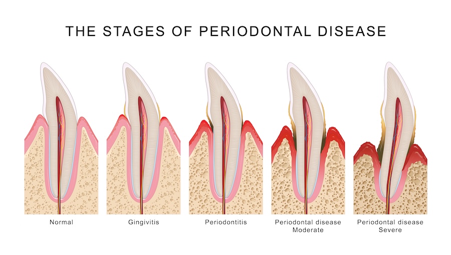stages of gum disease, signs of gum disease